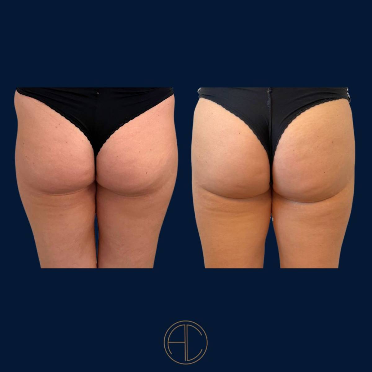 lipofilling fessier à Marseille par le Dr Chossat
