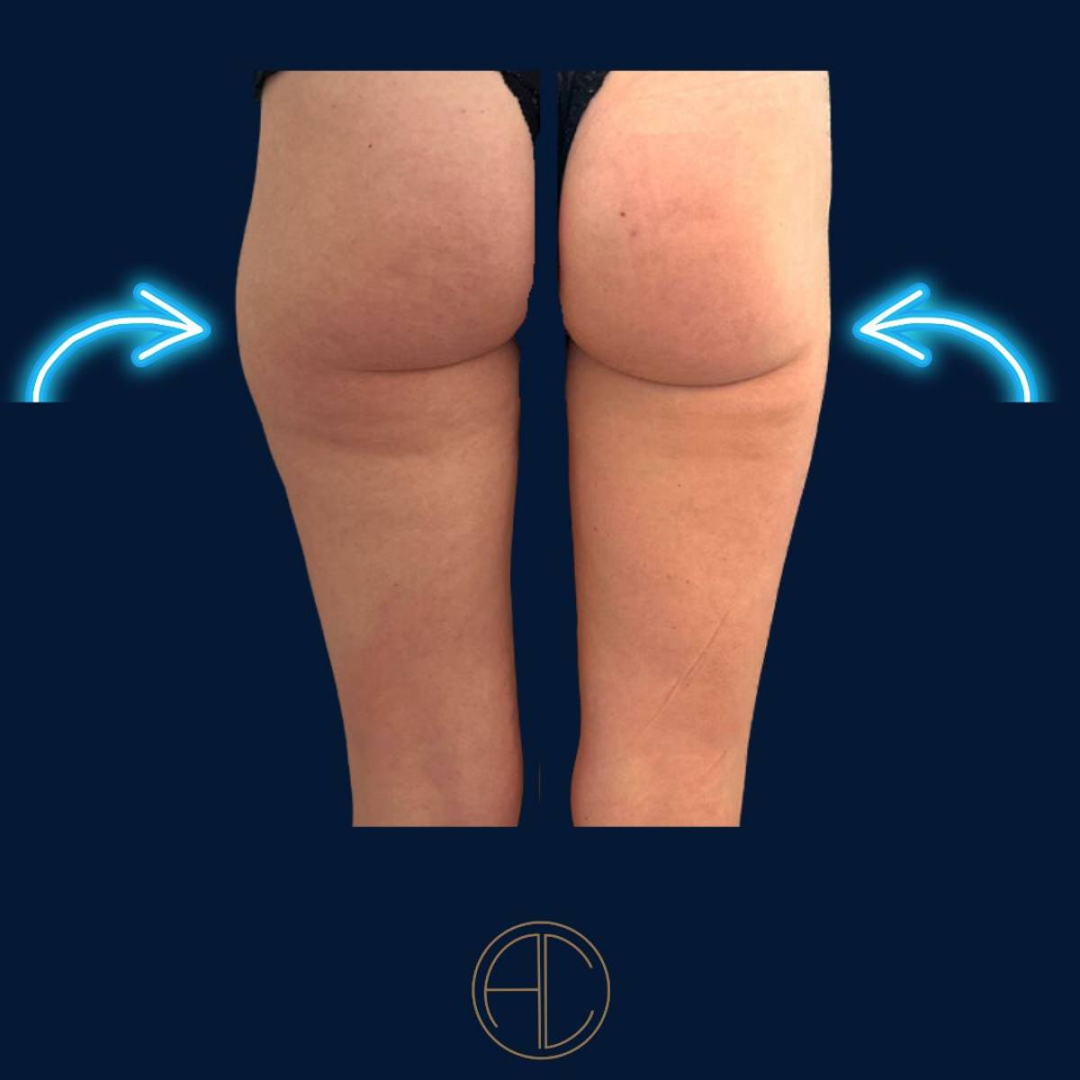 Liposuccion de la culotte de cheval à Marseille par le Dr Chossat