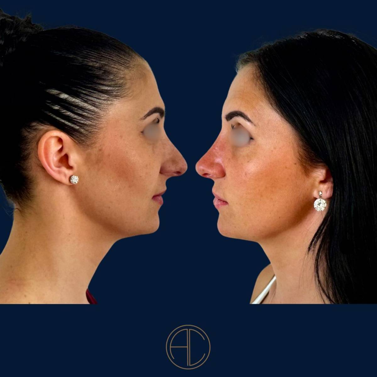 Rhinoplastie à marseille par le dr Chossat