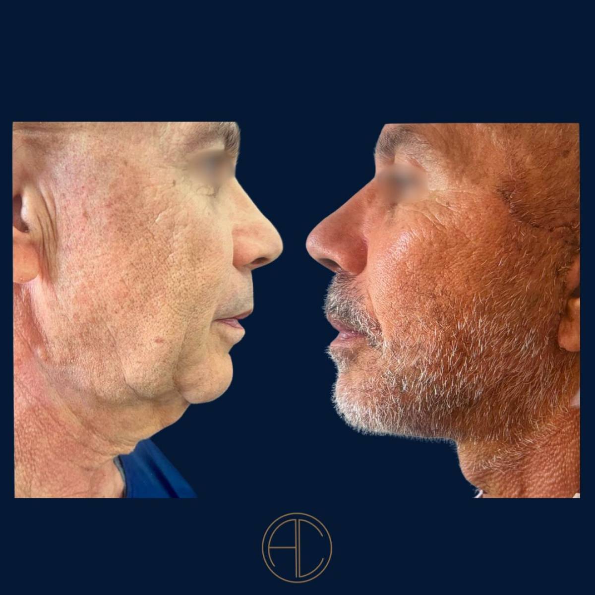 Lifting cervico-facial à Marseille par le Dr Chossat